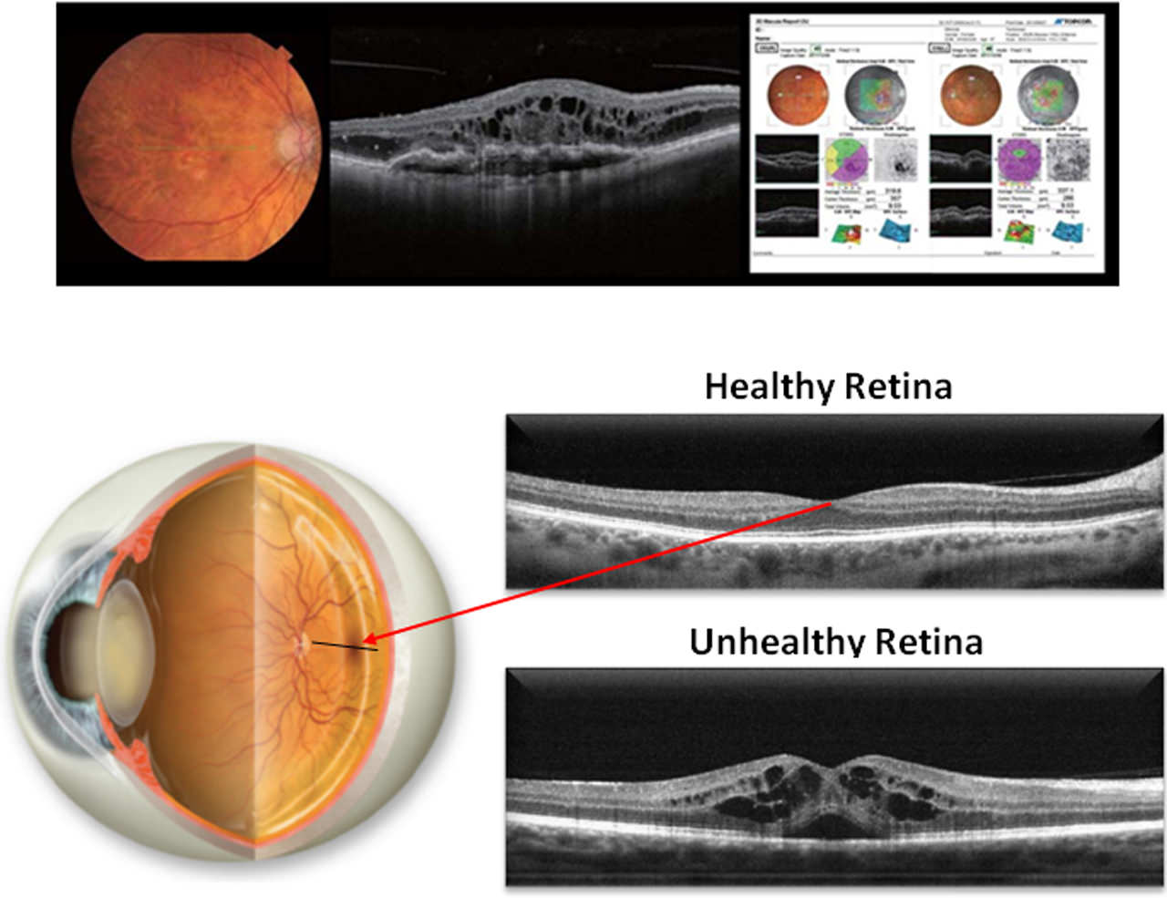 Retina